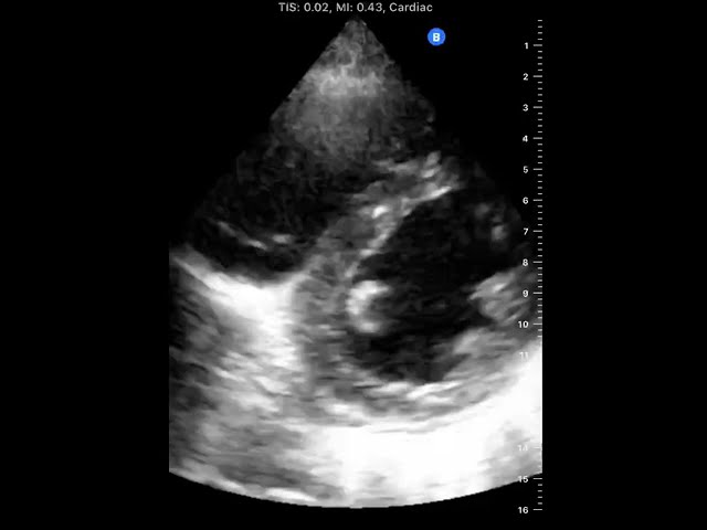 Flat interventricular septum (D-shaped LV; D sign) in pulmonary hypertension