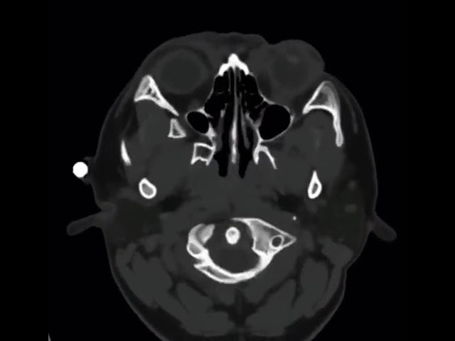 Head CT of Sturge–Weber syndrome (encephalotrigeminal angiomatosis) #cool #brain #doctor #medicine