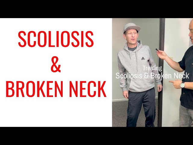 Scoliosis & Broken Neck gets treated by Chiropractor