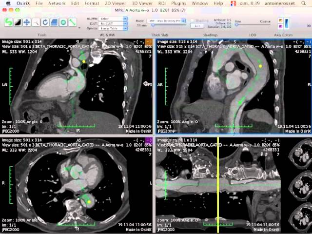 Aorta Segmentation in Curved MPR : Pre-Operative Measurements