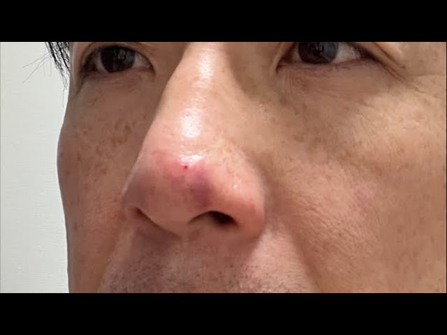 夢から覚めて❗️鼻、殴られたっぽくな〜い⁉️  #小山恵吾