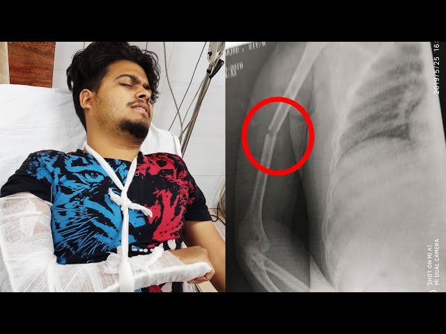 Kyaa Huaa Mere Saath Kaise Tuta Hath Accident????