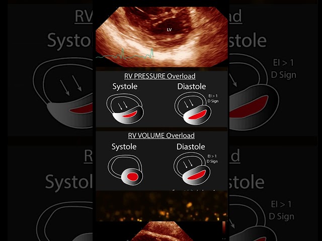 What is the D Sign? 📈 Echo Example Showing D Sign in Systole & Diastole!