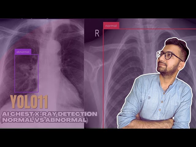YOLO11: AI Chest X-Ray Detection (Normal vs Abnormal)