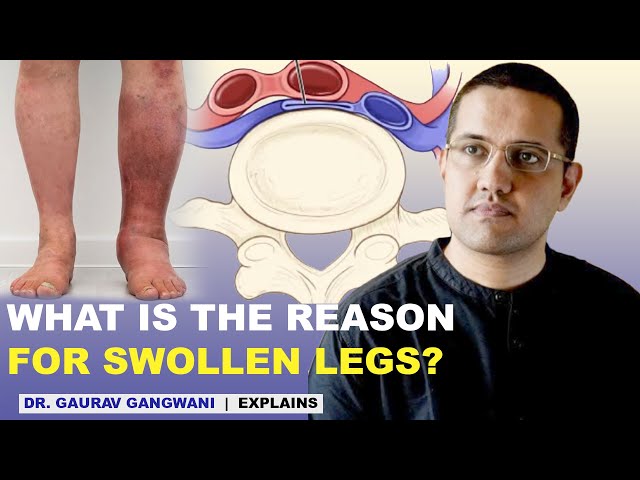 Swollen feet | Ankle swelling | Leg swelling | May Thurner syndrome | Dr. Gaurav Gangwani