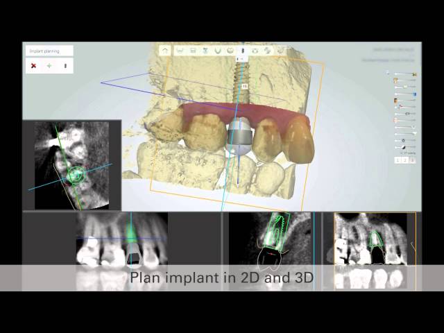 3Shape's new Implant Studio™