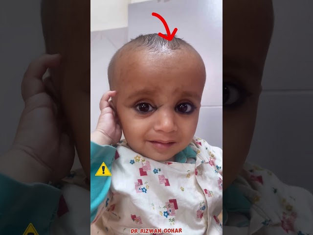 Vitamin-D Deficiency #Rickets