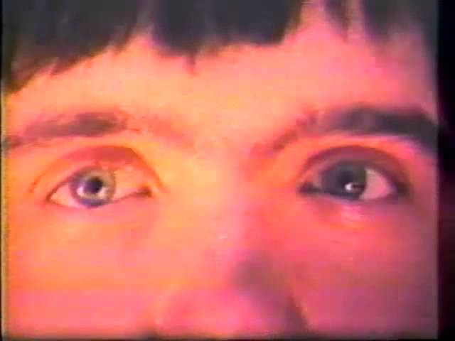 Convergence Retraction Nystagmus (Parinaud's Syndrome)