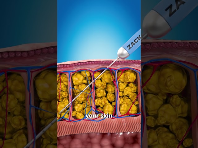 How Liposuction Works 💉🤔