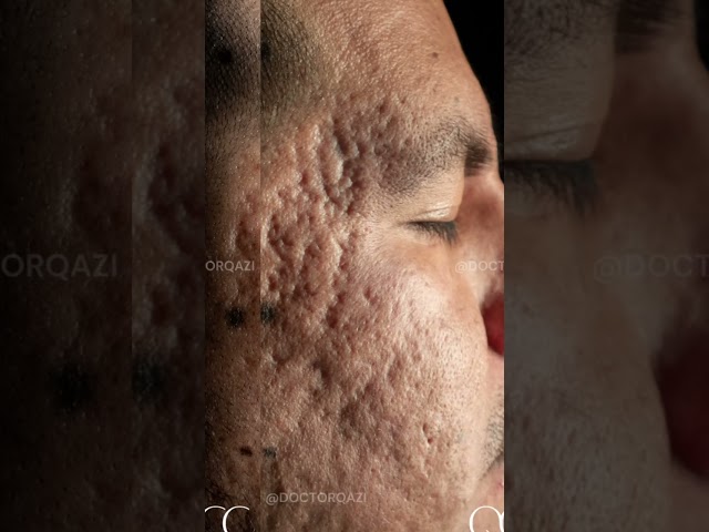 Severe Acne Scar Transformation #SkinRestoration