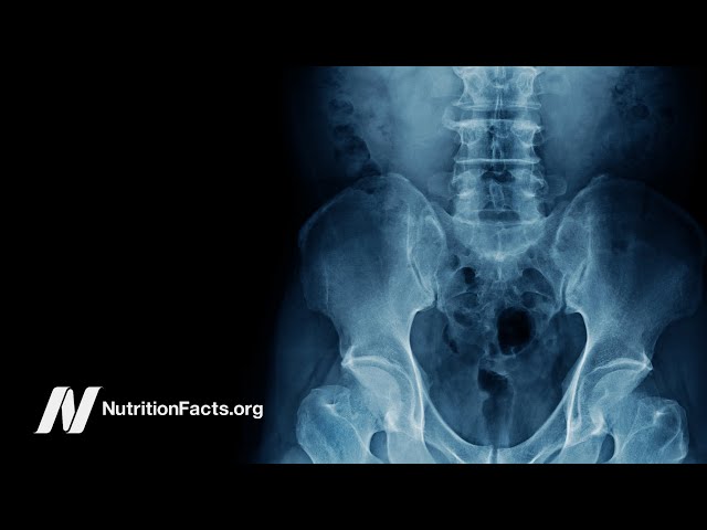 Do Vegans Have Lower Bone Mineral Density and Higher Risk of Osteoporosis?