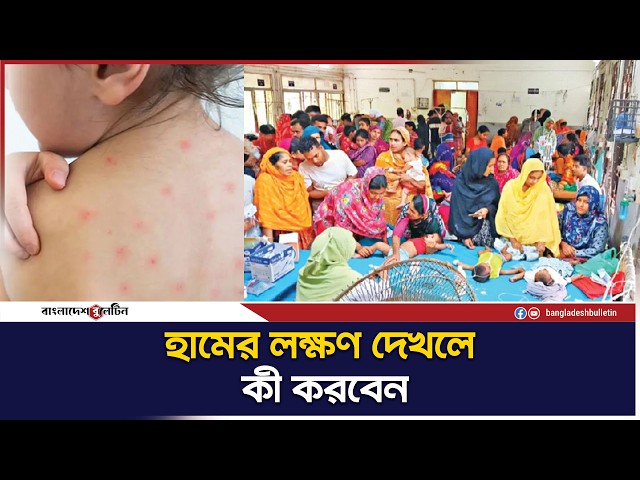 হাম ছড়াচ্ছে দ্রুত সতর্ক থাকার উপায় জানুন | Bangladesh Bulletin