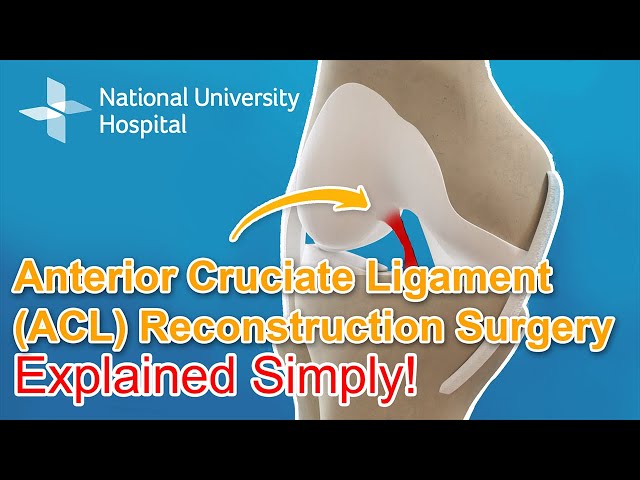 Anterior Cruciate Ligament (ACL) Reconstruction Surgery - Explained