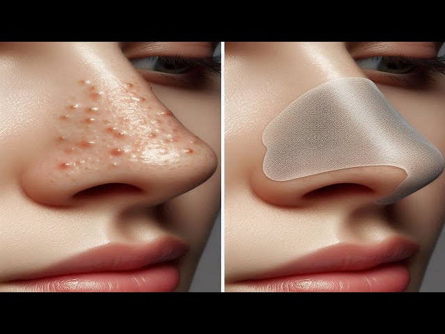 How to Get rid of Blackheads