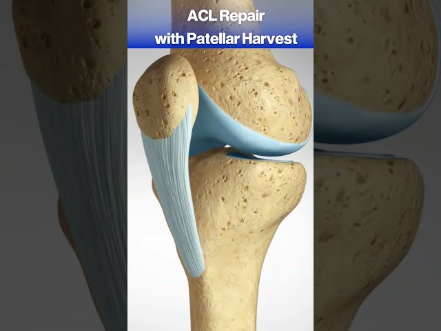 What happens when you tear your ACL? #acl #knee #kneepain