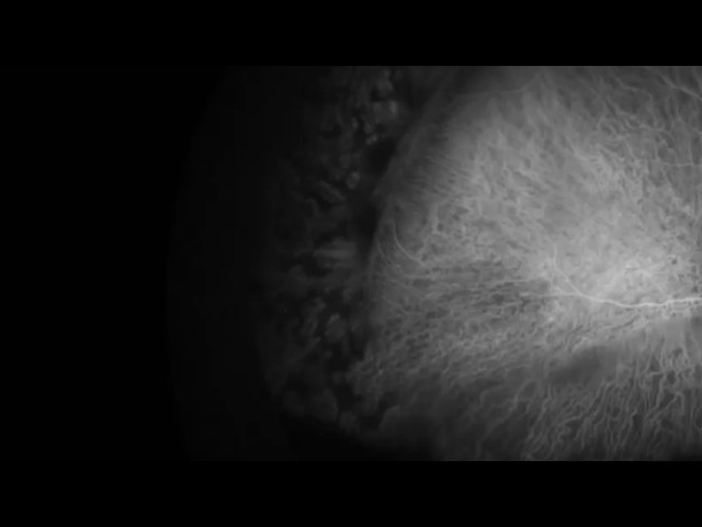 360 Video demonstrating non contact ultra wide field imaging for screening of ROP