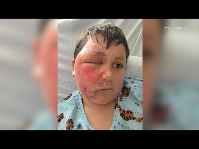 9-year-old severely burned after following TikTok trend