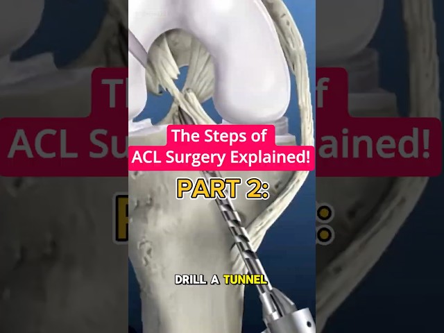 ACL Reconstruction Explained (Part 2) | Graft Fixation & Final Steps
