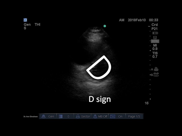 POCUS Pulmonary Embolism (D sign) Before and After Thrombolysis