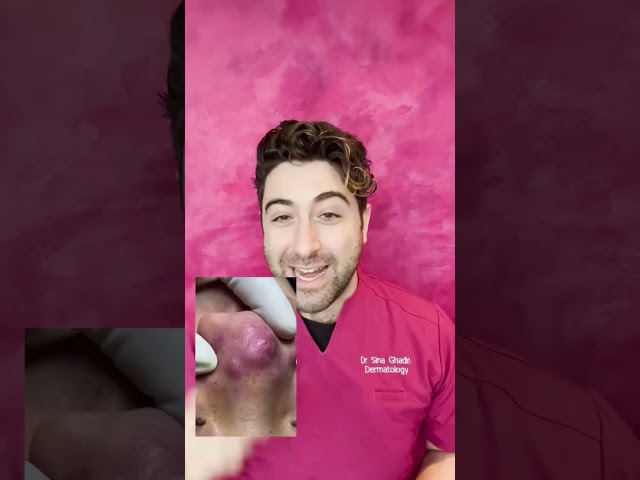 INFLAMED ACNE on the nose