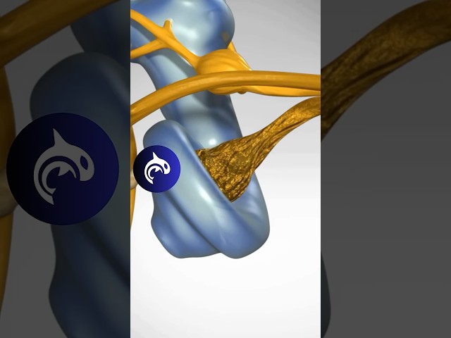 See how Hearing Loss from Nerve Degeneration works in 3D Animation.